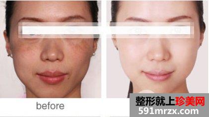 ����ȥ�ƺְ߶�Ƥ�����˺�����Σ����