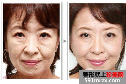 电波拉皮可以去除哪些部位的皱纹