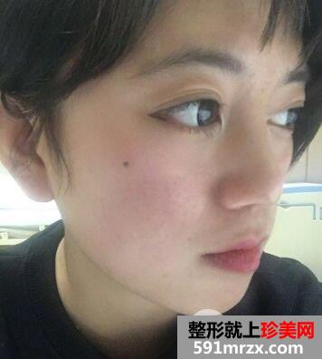 耳软骨垫鼻尖|鼻尖美容术案例前后对比效果图