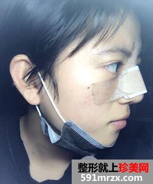 耳软骨垫鼻尖|鼻尖美容术案例前后对比效果图