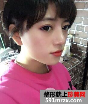 耳软骨垫鼻尖|鼻尖美容术案例前后对比效果图