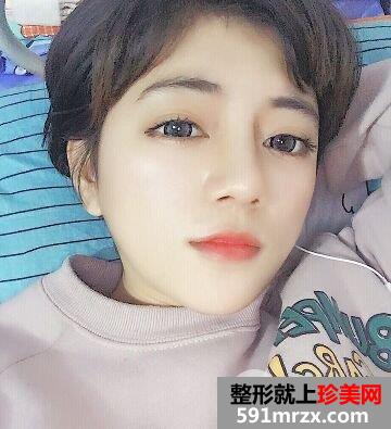 耳软骨垫鼻尖|鼻尖美容术案例前后对比效果图