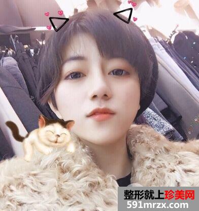 耳软骨垫鼻尖|鼻尖美容术案例前后对比效果图