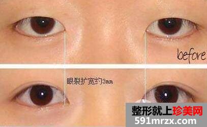 开眼角会对眼睛不好吗?