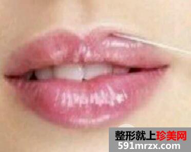 唇珠成形是否有副作用?