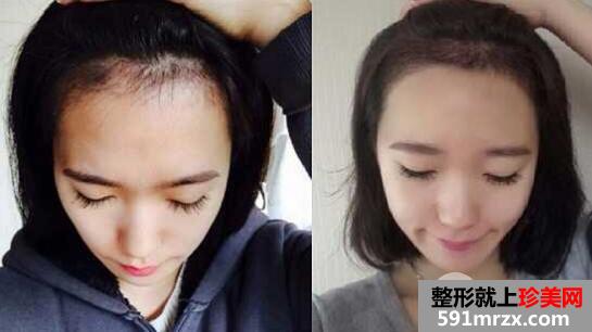 发际线种植是否容易脱落吗?