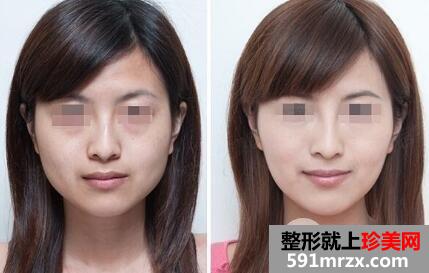 瘦脸针瘦脸前后对比图