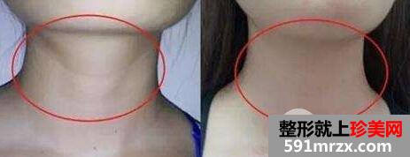 脖子颈纹很深怎么消除?去颈纹最有效的方法介绍