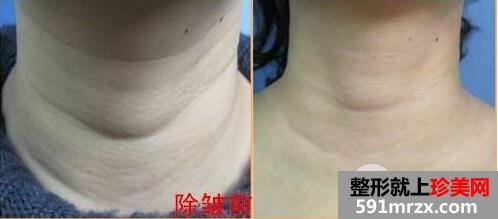 脖子颈纹很深怎么消除?去颈纹最有效的方法介绍