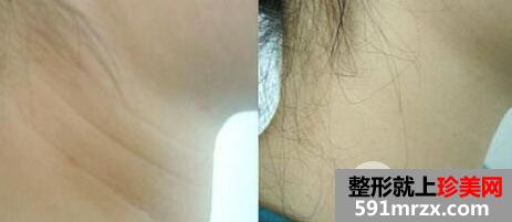 脖子颈纹很深怎么消除?去颈纹最有效的方法介绍