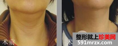 脖子颈纹很深怎么消除?去颈纹最有效的方法介绍