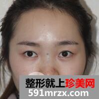 安徽现代医学美容医院隆鼻鼻综合术前术后对比照来咯!