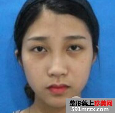 ���������沿֬�������ʵ�������沿��Ŀ�۸����