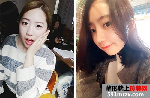 ���������¡����ǰ��Ч���Ա�ͼ�ͻָ�����