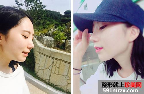 ���������¡����ǰ��Ч���Ա�ͼ�ͻָ�����