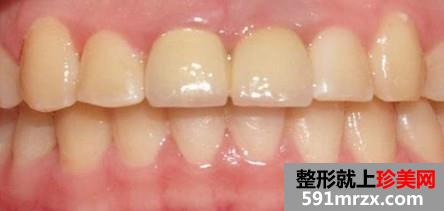 ��ֲ��,ǰ��,�Ա�,Ч��,ͼƬ,�ָ�,����