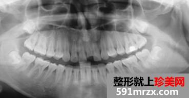 ��ֲ��,ǰ��,�Ա�,Ч��,ͼƬ,�ָ�,����