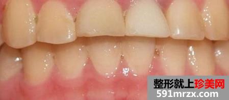 ��ֲ��,ǰ��,�Ա�,Ч��,ͼƬ,�ָ�,����