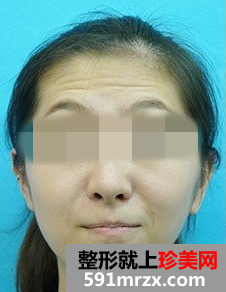 �沿�ڿ���ȥ��̧ͷ��ǰ��Ա�Ч��ͼƬ�ͻָ�����