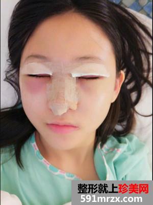 耳软骨鼻综合加眼综合手术恢复日记分享给大家