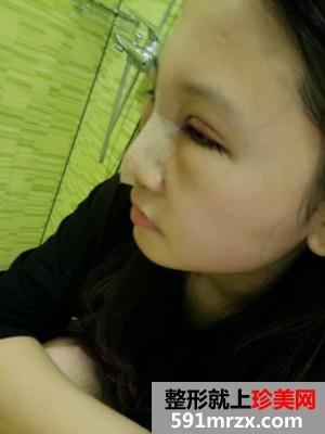 耳软骨鼻综合加眼综合手术恢复日记分享给大家