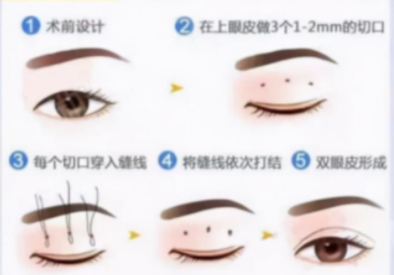 石家庄定点双眼皮哪家医美整形医院做的比较好？