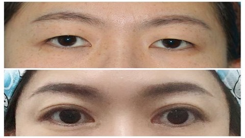 切了双眼皮怎么消肿快