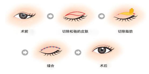 割双眼皮一般要多少钱啊
