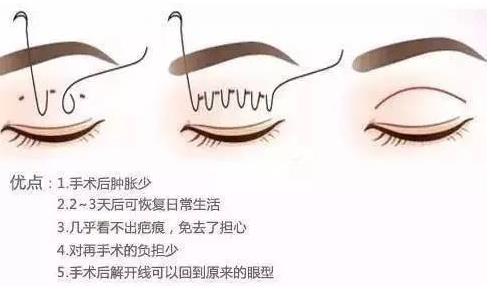 长沙埋线双眼皮价格 长沙埋线双眼皮价格