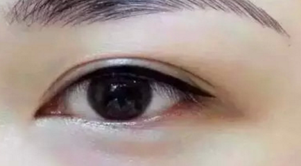 拉双眼皮多久消肿