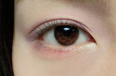 双眼皮术哪里做的好
