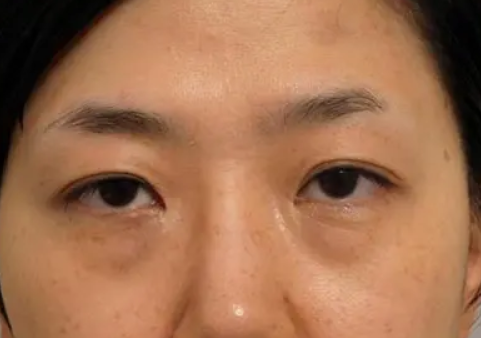 外切眼袋多久可以同房