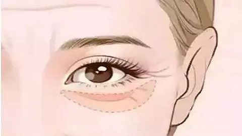 深圳全切法去眼袋哪家美容机构口碑比较好？