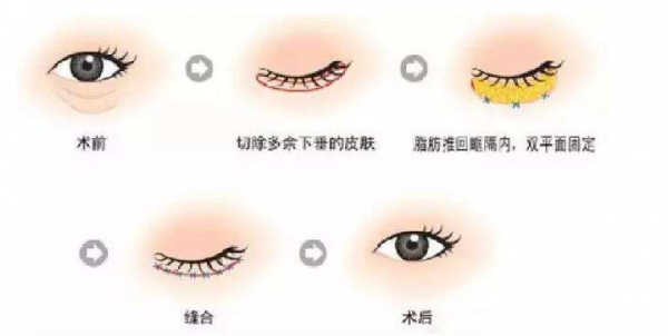 男士去眼袋要多少钱