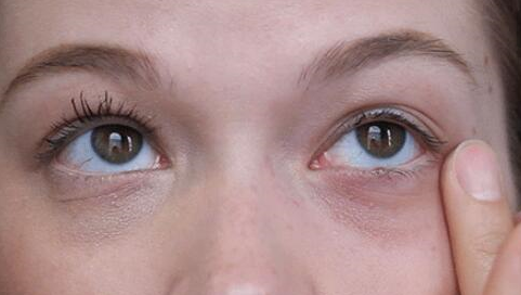 做去眼袋效果如何 做去眼袋效果如何