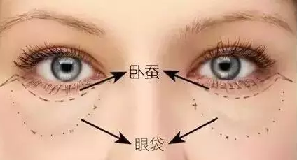 怎么去除脂肪型眼袋