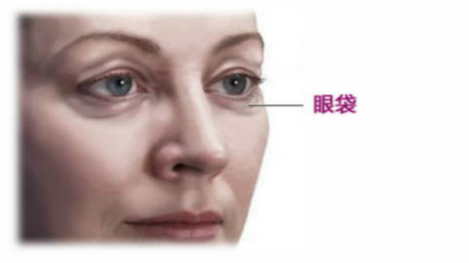 眼袋怎么消除