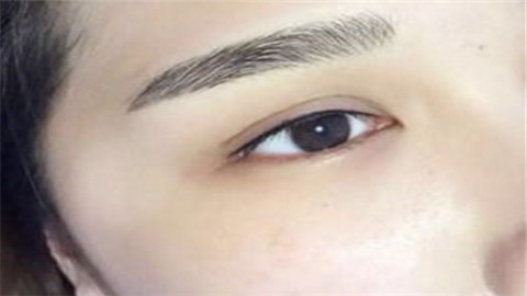 抽脂法去眼袋能维持多久