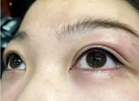眼袋整形手术有后遗症吗