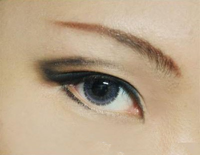 眼袋切除术痛苦吗