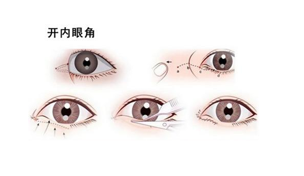 现在开眼角大概多少钱