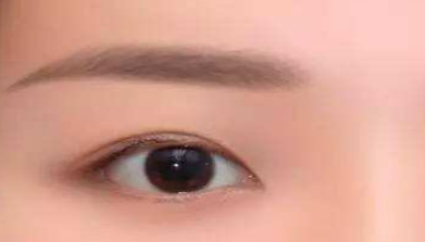 韩式无痕开眼角多久能好