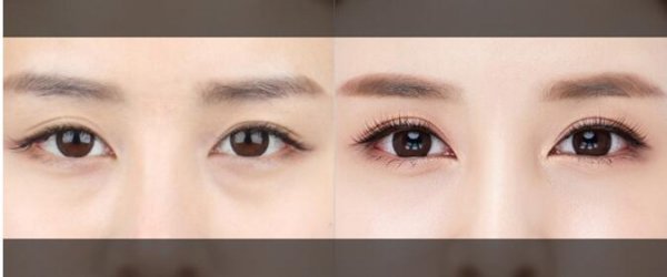 南京开眼角的效果如何呢?