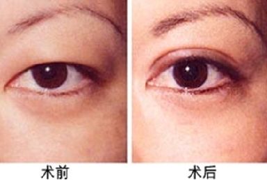 割双眼皮后多久能洗澡 割双眼皮后多久能洗澡