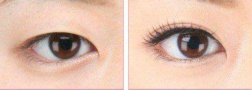 割双眼皮的效果持久吗 割双眼皮的效果持久吗