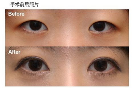 哪些人适合开内眼角手术