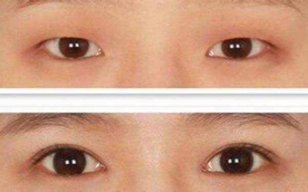 开外眼角的效果和优势