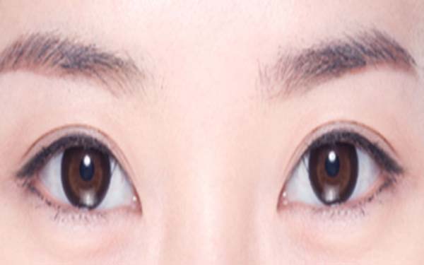 韩式无痕开眼角手术方法
