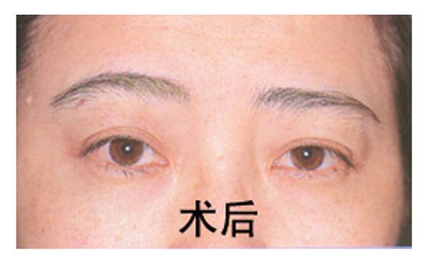 开外眼角后遗症的常见表现