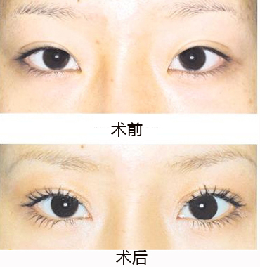 北京开内眼角哪里比较好 北京开内眼角哪里比较好